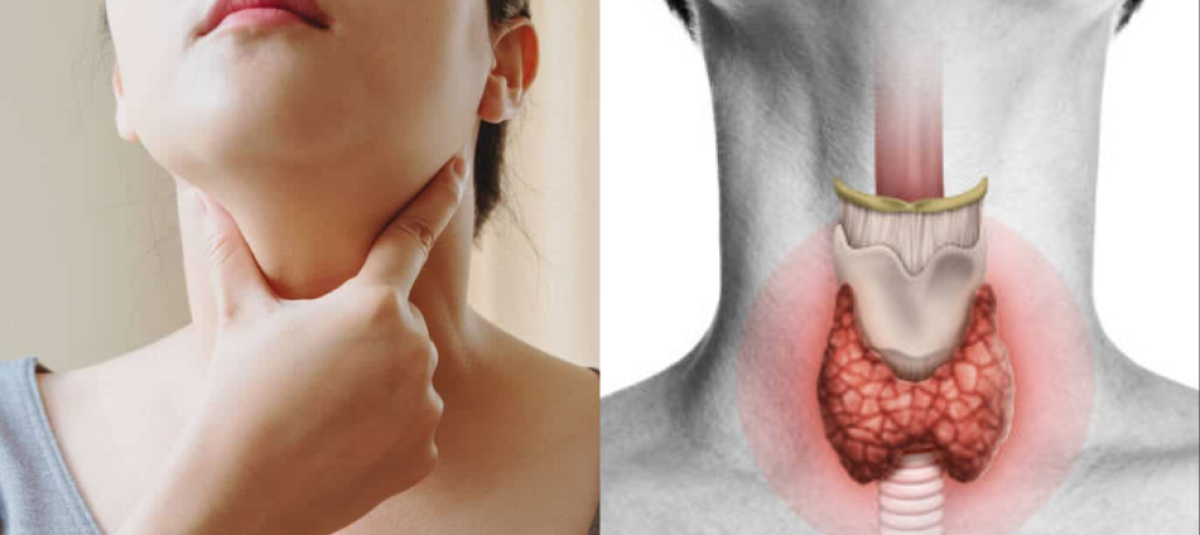 Por qué el hipotiroidismo es más común en mujeres? Expertos responden