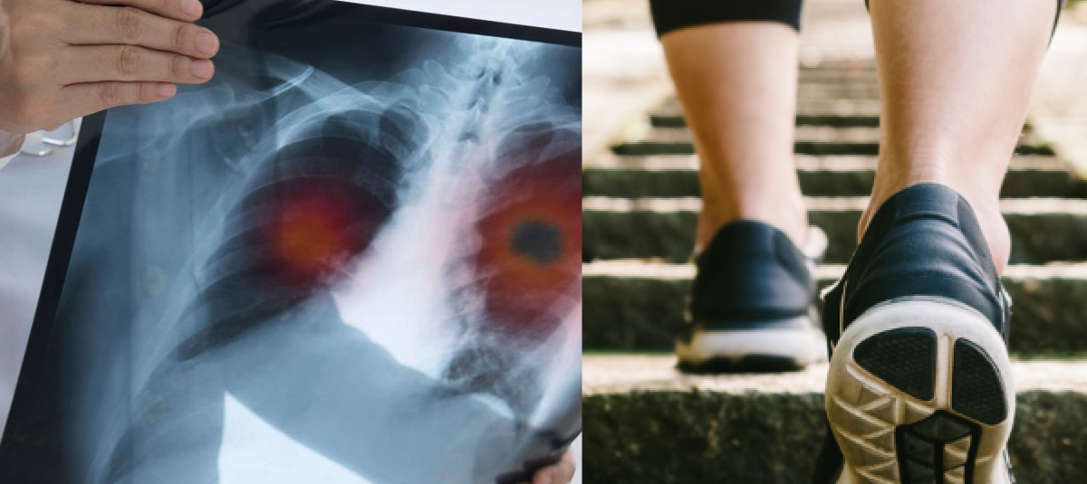 cáncer de pulmón