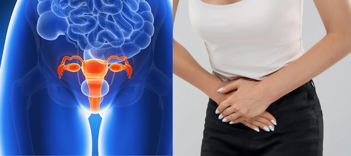 cáncer de ovario