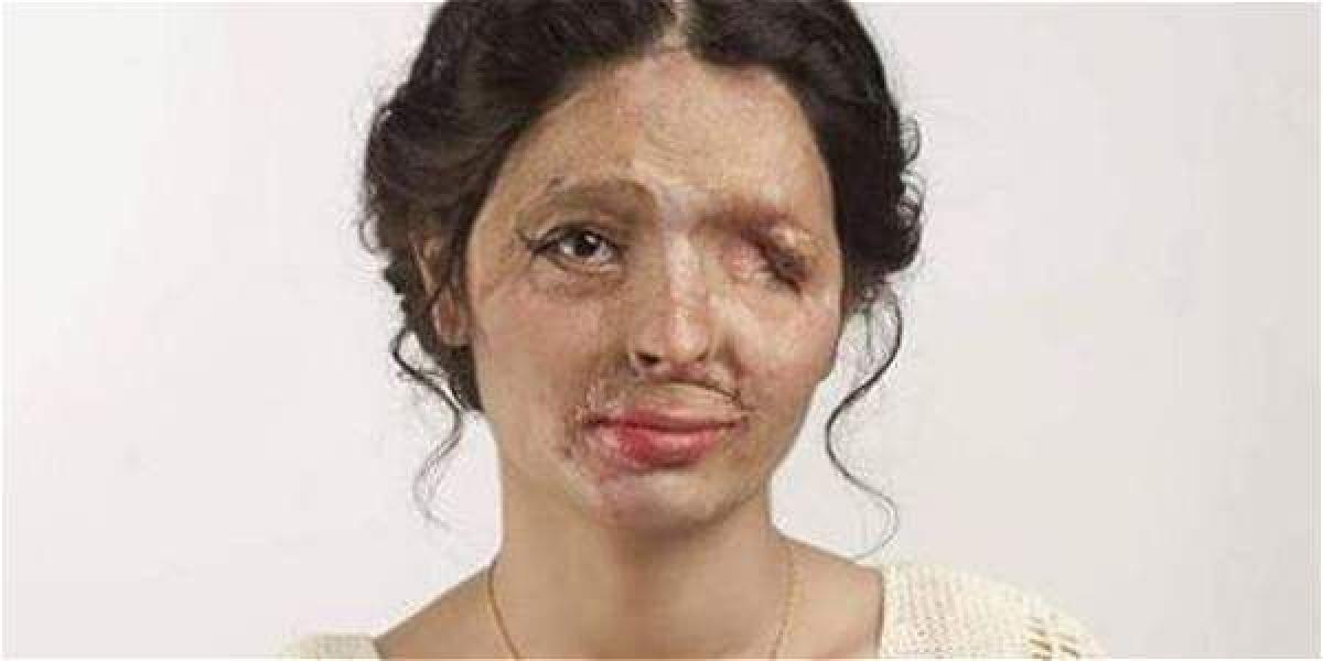 Reshma Qureshi fue rociada con ácido en 2014 por su cuñado, quien la culpaba de que su hermana lo hubiera dejado.