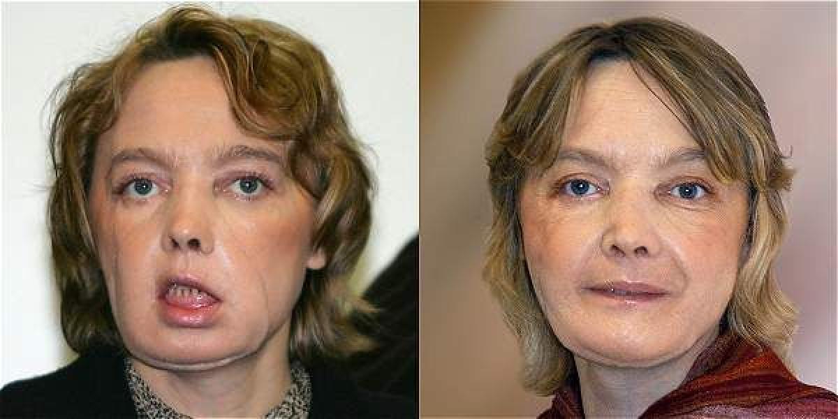 A la izquierda, Isabel Dinoire el 6 de febrero del 2006, semanas después de haber recibido el trasplante. A la derecha, imagen de la mujer en noviembre de ese año.