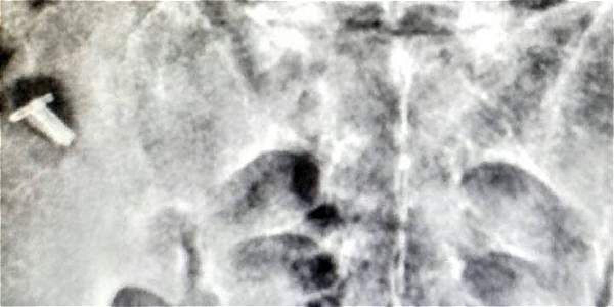 Esta radiografía que dejaría ve el objeto la dio a conocer el señor Fánor Calero.