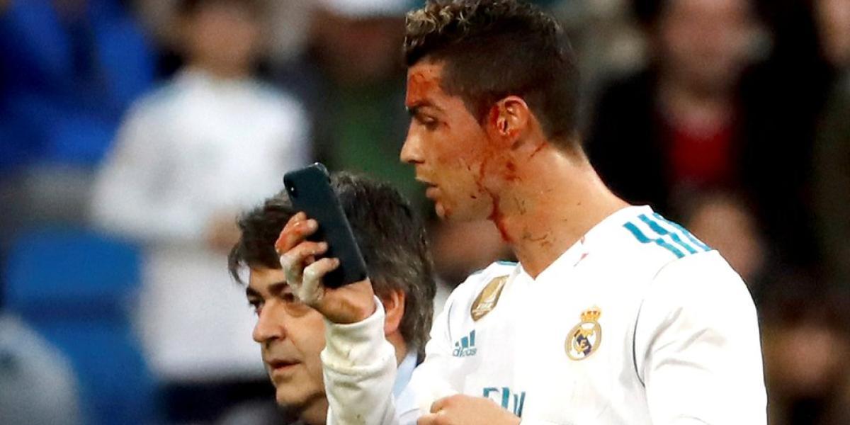 Un golpe en la cabeza de Ronaldo le provocó un corte cerca de su ojo, pero su reacción fue lo que llamó más la atención.