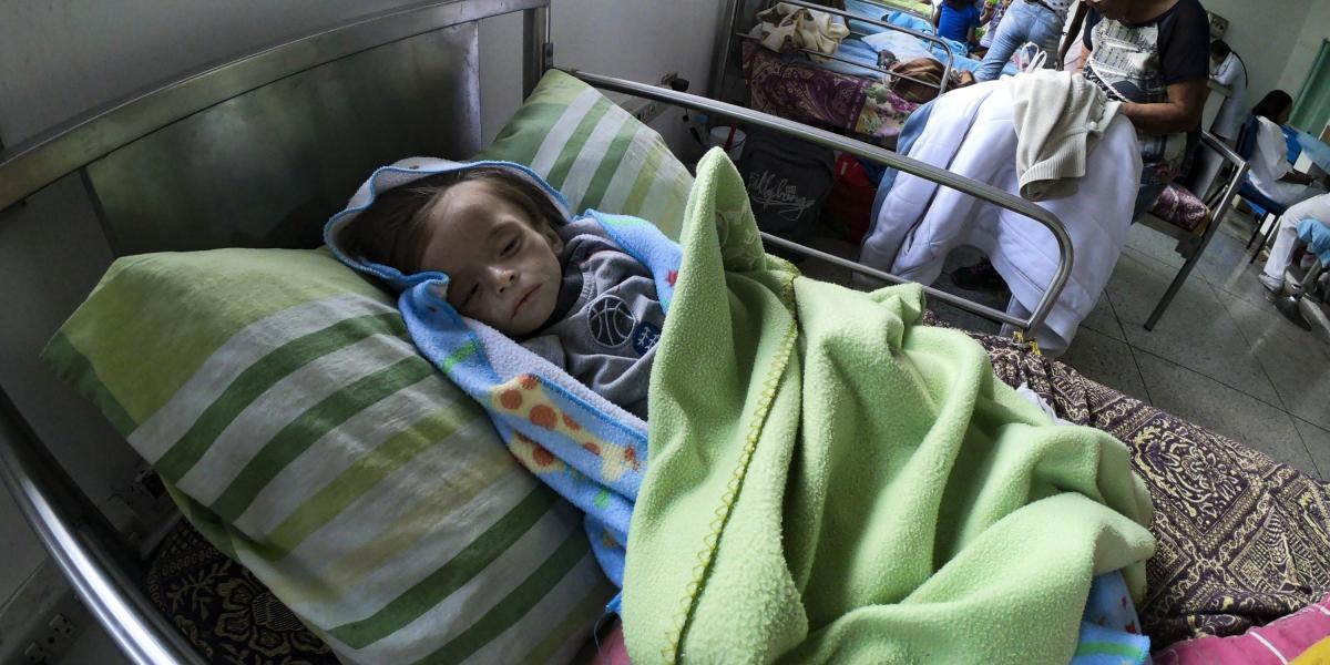 Un pequeño con desnutrición severa reposa en la cama de un hospital en la ciudad de Maracay, Venezuela.