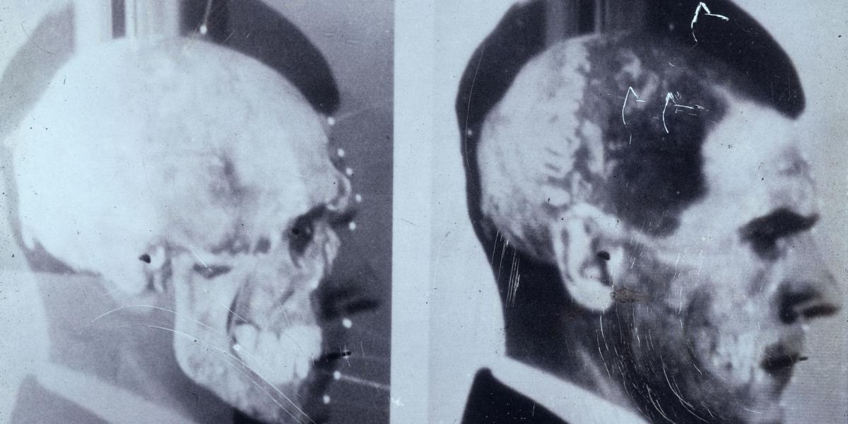 En 1985 científicos alemanes utilizaron una técnica innovadora de sobreponer imágenes para confirmar que el cráneo exhumado en Embu era de Josef Mengele.