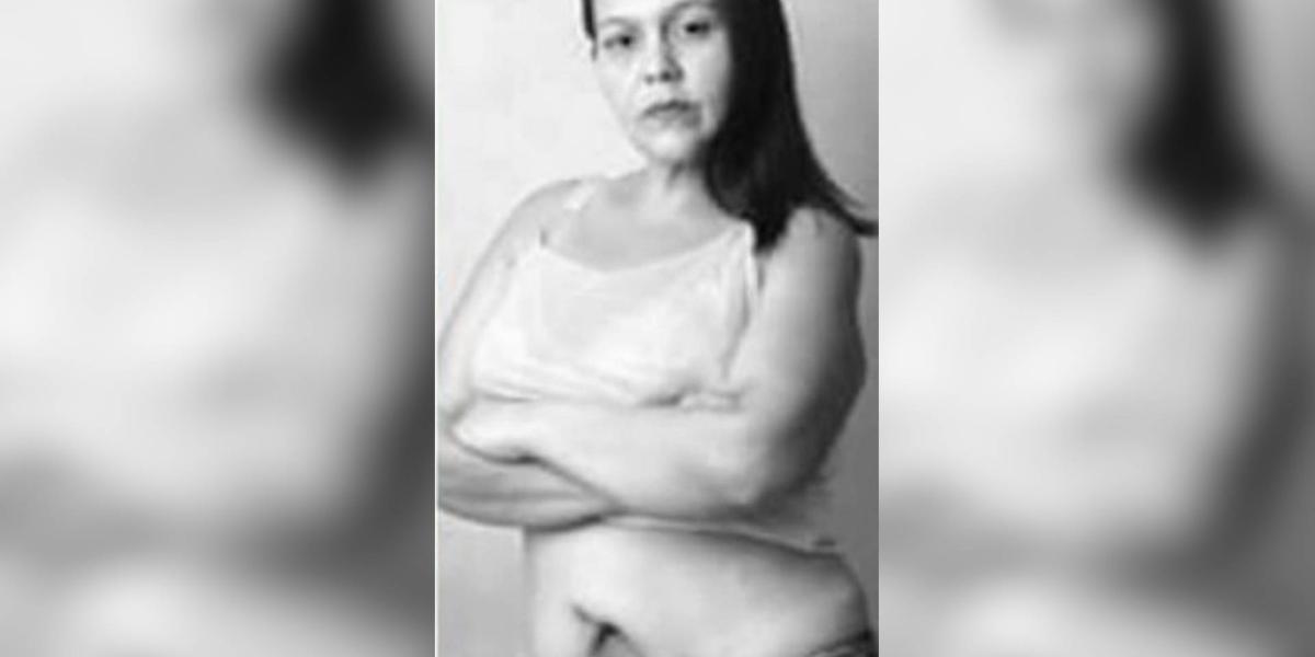 El médico Ramiro Alberto Pestana le realizó una abdominoplastia a Diana Paola Cordero en el 2011, quien semanas después empezó a sufrir complicaciones en su cuerpo.