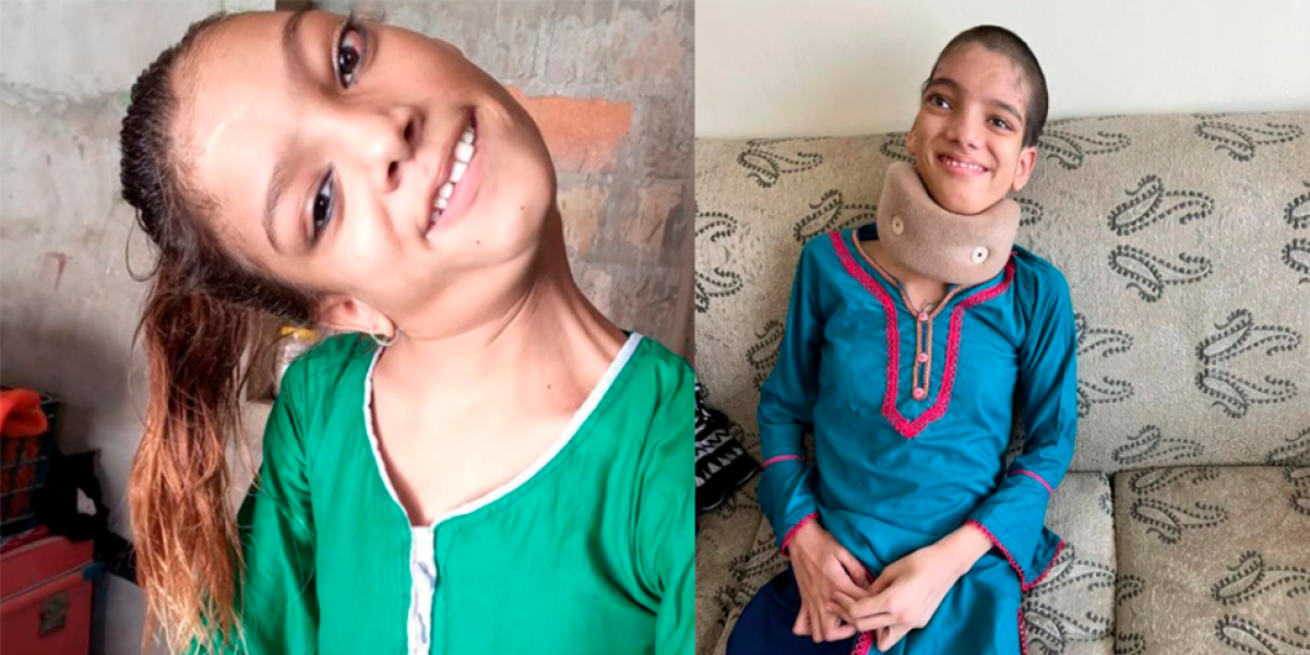 Afsheen Gul, la niña que vivió con su cuello rotado 13 años.