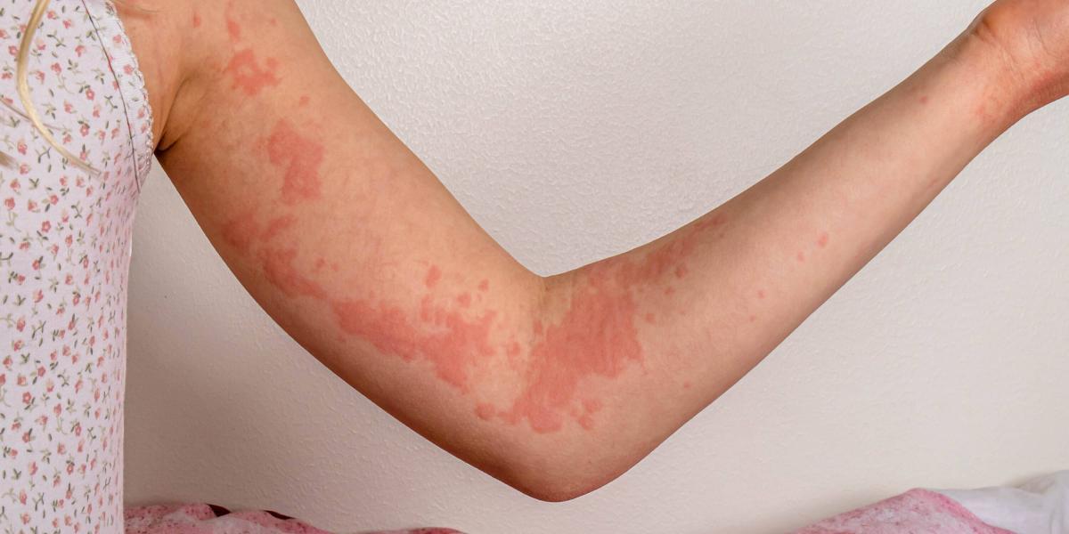 Qué es la urticaria y cuáles son sus síntomas