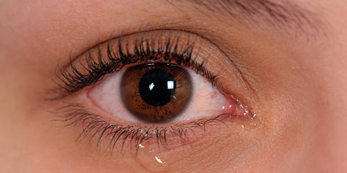 La causa de los ojos llorosos es la obstrucción de los conductos lagrimales.