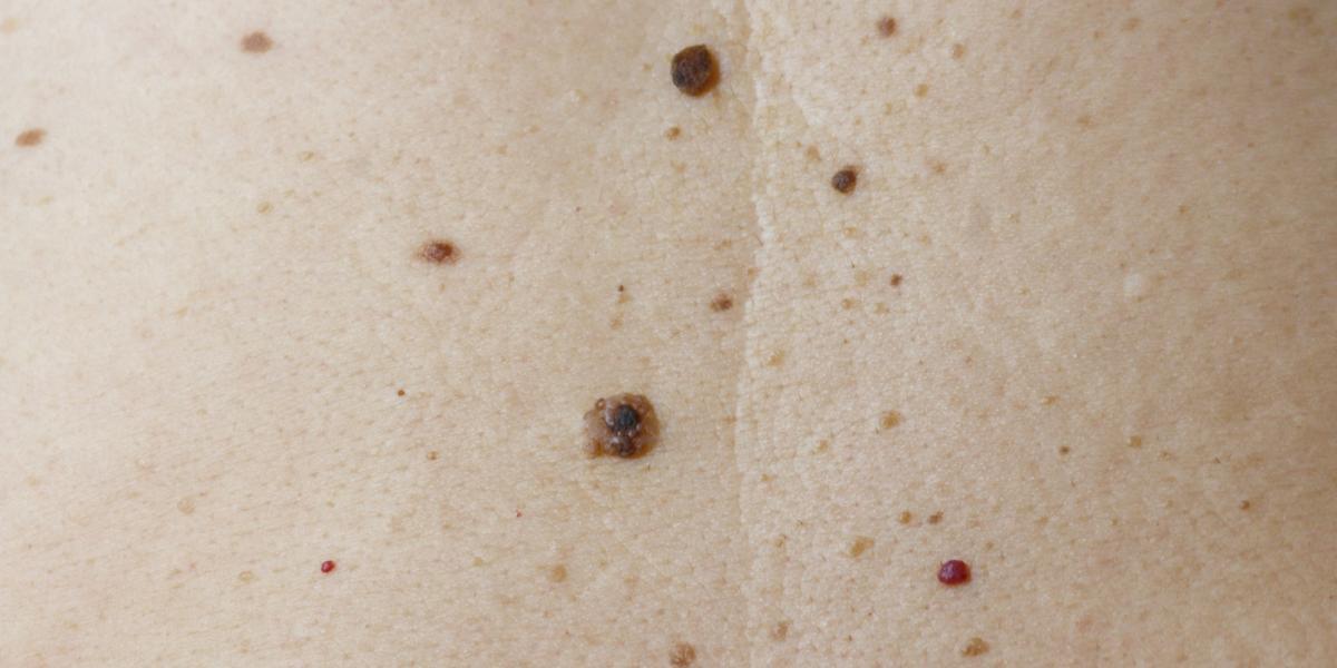 Queratosis seborréica: cuándo ir al médico ante manchas que salen en el ...