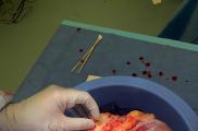 Un hígado tras ser extraído de un donador fallecido.