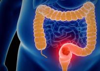 Con una colonoscopia se puede ver si hay pólipos en el colon, cáncer de colon o lesiones vasculares.