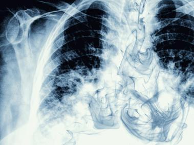 A los pacientes con cáncer de pulmón se los considera responsables de su enfermedad porque está asociada principalmente al cigarrillo.