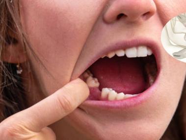 El dolor de muela se puede dar los las bacterias entre los dientes y las encías.