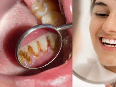 Remedios caseros para combatir el sarro dental: ¿cuáles son los más efectivos?