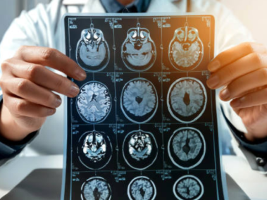 accidente cerebrovascular