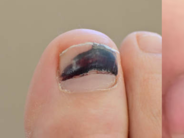 Si duda de lo que tiene en sus uñas, asista al médico.