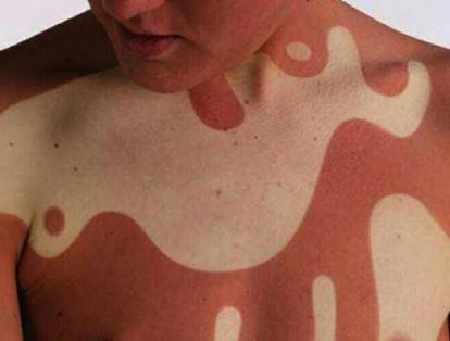El Sunburn art consiste en aplicarse bloqueador solar en algunas partes del cuerpo para lograr diseños y formas que parezcan tatuajes.