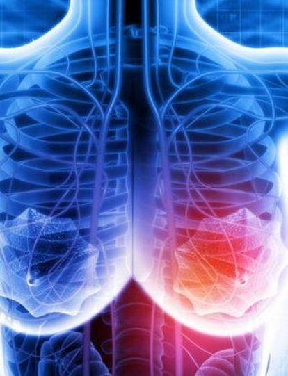 Estudio sobre el cáncer de mama