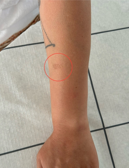 Esta es una mancha de nacimiento que tiene Maryi.