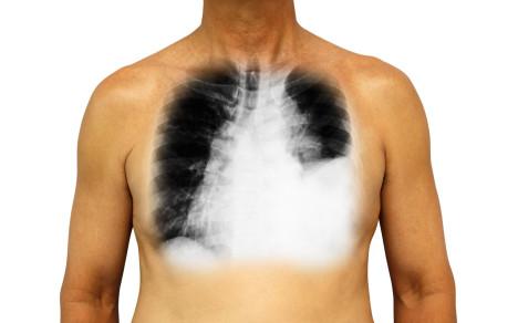 El cáncer de pulmón no solo es consecuencia del tabaquismo, recuerda el informe.