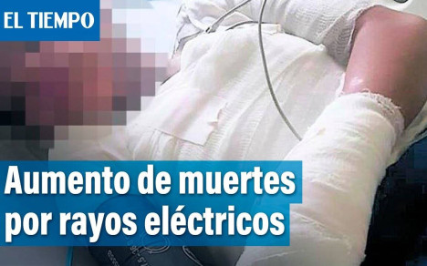 Se han reportado 757 muertes por descargas eléctricas en Bogotá en el último año. Una persona impactada por un rayo puede presentar quemaduras profundas, daño de órganos y tejidos, amputaciones de las extremidades e incluso la muerte.