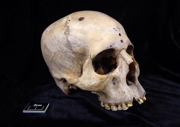 Se hallaron marcas de corte alrededor de lesiones en un cráneo que data de entre 2687 y 2345 a.C.