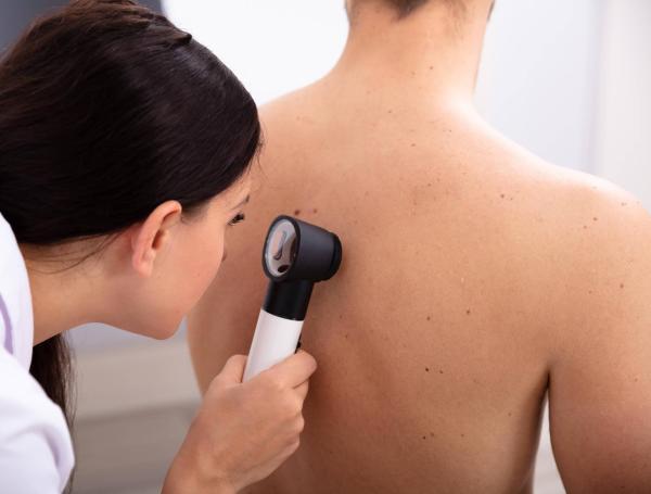 Si detecta una lesión en la piel, es importante que acuda a un dermatólogo.