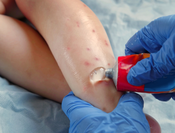 Acuda al médico si presenta algún síntoma relacionado con el dengue.