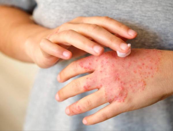 El eczema resulta molesto para muchas personas