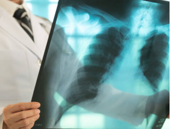 tuberculosis