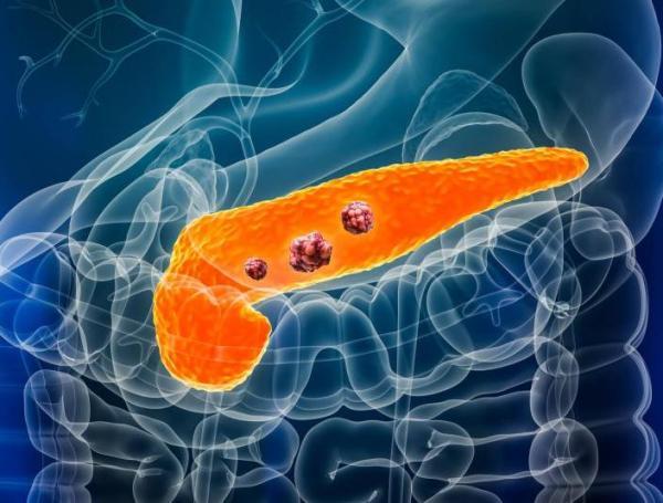 Cáncer de pancreas