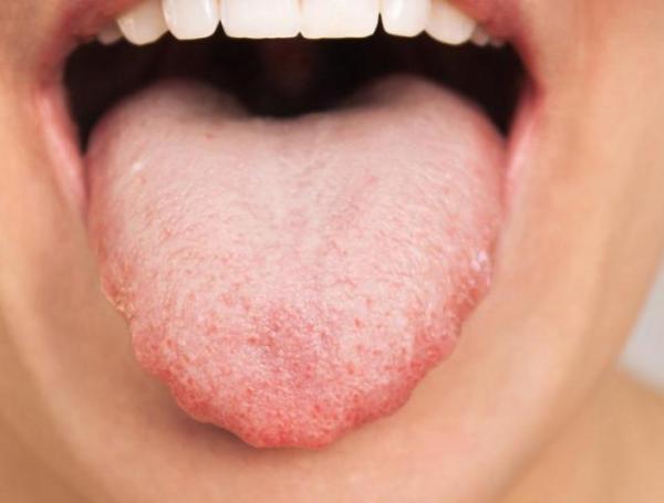 Cáncer de lengua