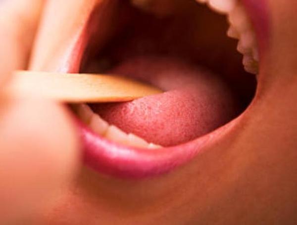 Cáncer de lengua