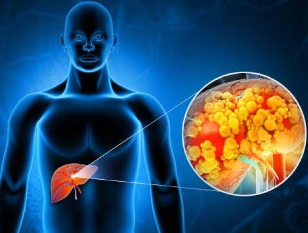 cáncer de hígado