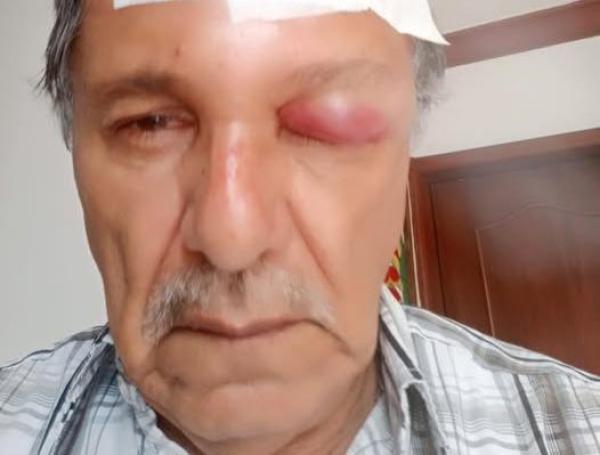 Hugo Romero, camarógrafo, de 70 años, que resultó herido por golpes de un motociclista