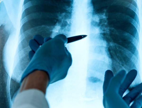 Radiografía del pulmones, padres de menor reclaman negligencia médica