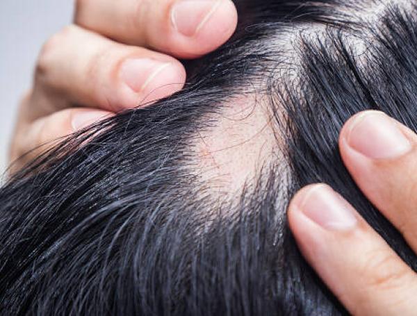 La terapia acude a los denominados exosomas.