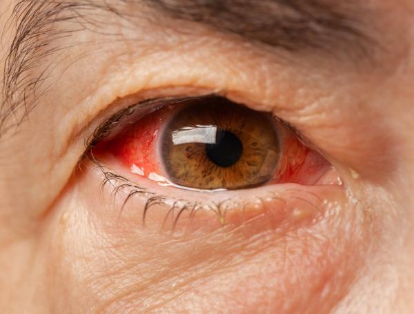Los síntomas del glaucoma varían dependiendo el tipo. Por lo general, son silenciosos.