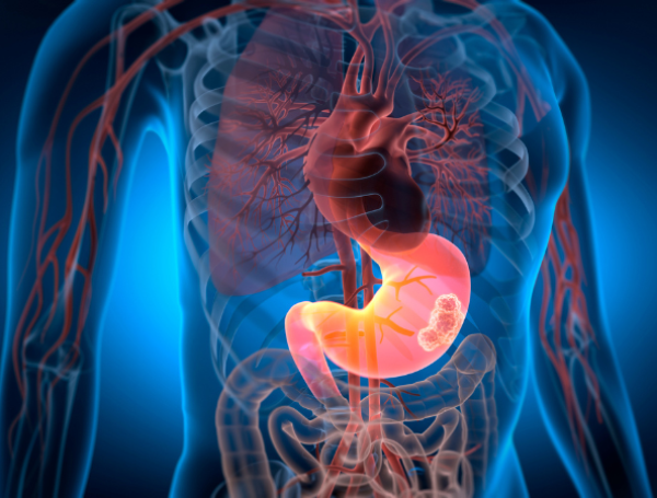 Cáncer de estómago
