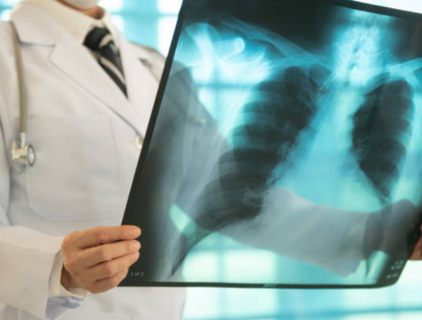 cáncer de pulmón