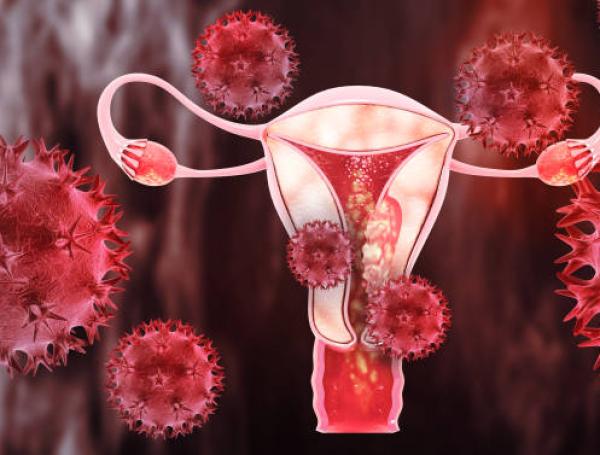 El cáncer de ovario puede prevenirse