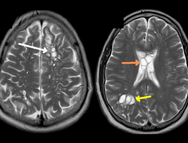 Hombre con neurocisticercosis