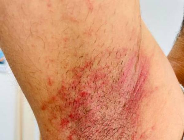 Así se puede ver una axila por una infección o por una reacción alérgica.