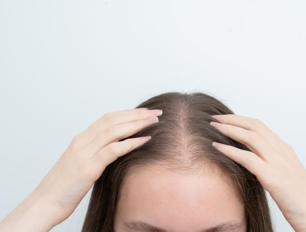 Alopecia