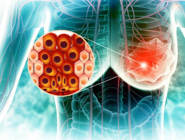 cáncer de mama