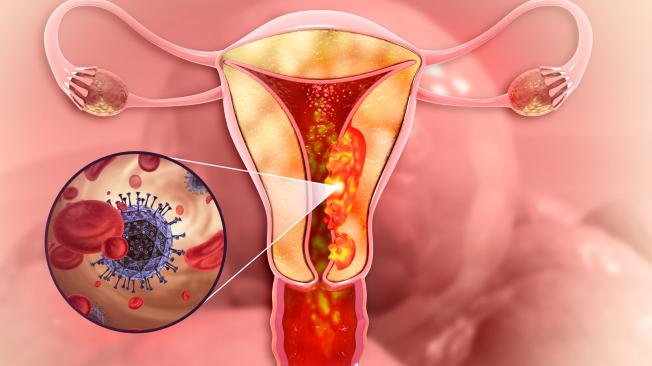 Cáncer de ovario.