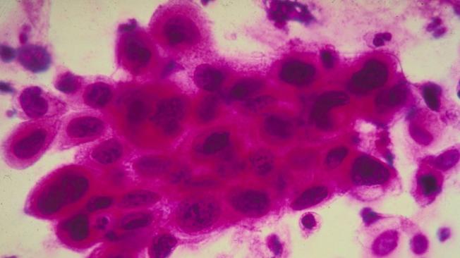 La prueba del Papanicolaou puede detectar las céculas precancerígenas antes de que se desarrolle la enfermedad.