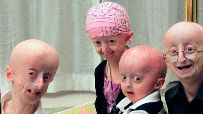 Un grupo de pacientes con progeria.