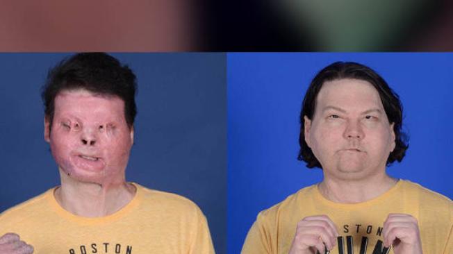 Joe DiMeo tuvo graves quemaduras en su rostro. La imagen de la derecha corresponde a su aspecto después de la cirugía exitosa.